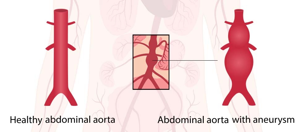 אילוסטרציה רפואית המציגה אאורטה בטנית בריאה לצד אאורטה בטנית עם מפרצת. התמונה מדגישה את ההבדלים במבנה כלי הדם.