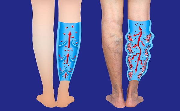 מהי מחלת ורידי הרגליים?