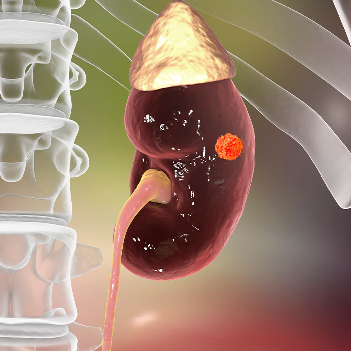 אילוסטרציה רפואית המציגה כליה עם גידול סרטני. התמונה מדגישה את המבנה האנטומי של הכליה והגידול הסרטני.