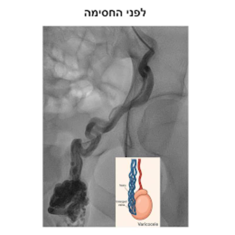 תיאור מקרה #1 : כאב אשכים ממושך בגבר צעיר – וטיפול מוצלח ללא ניתוח ...