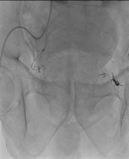תיאור מקרה #12 כשהערמונית ענקית וחוסמת הקטטר חוזר שוב ושוב